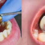 diseases caused by poor dental hygiene